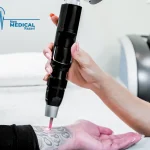 بهترین دستگاه‌های لیزر حذف تاتو