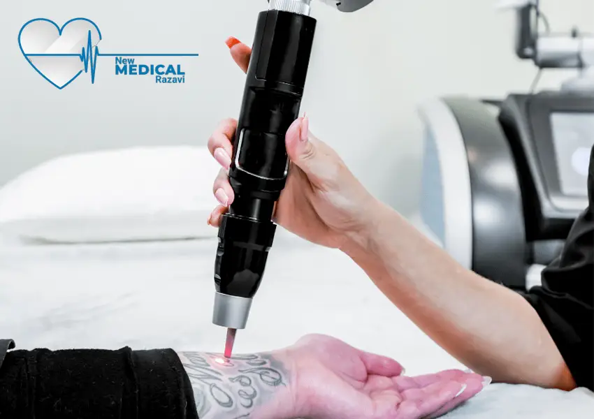 بهترین دستگاه‌های لیزر حذف تاتو