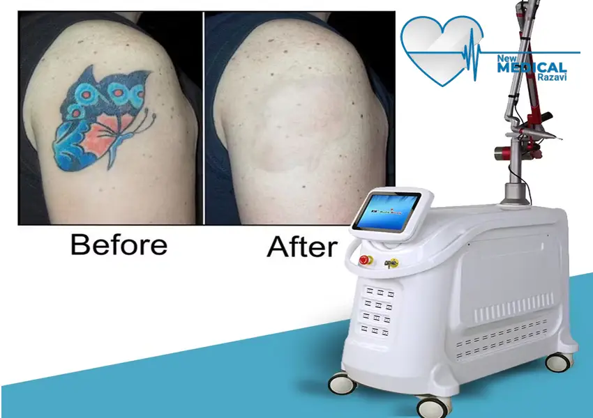 بهترین دستگاههای لیزر حذف تاتو