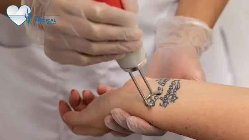 تعمیر دستگاه لیزر حذف تاتو در مشهد