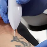 تعمیر دستگاه لیزر حذف تاتو در مشهد