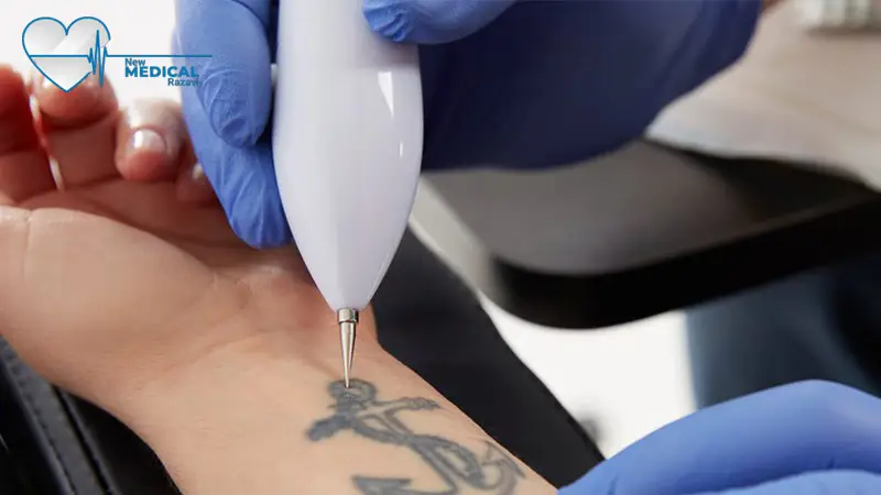 تعمیر دستگاه لیزر حذف تاتو در مشهد